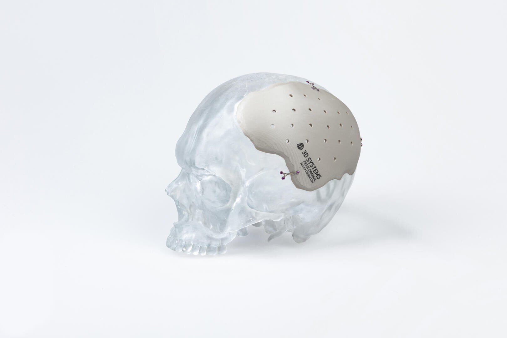 Ein transparentes Schädelmodell mit einem metallischen Schädelimplantat, das einen Teil der oberen linken Seite bedeckt, mit kleinen Löchern und medizinischen Markierungen, dargestellt vor einem schlichten weißen Hintergrund.