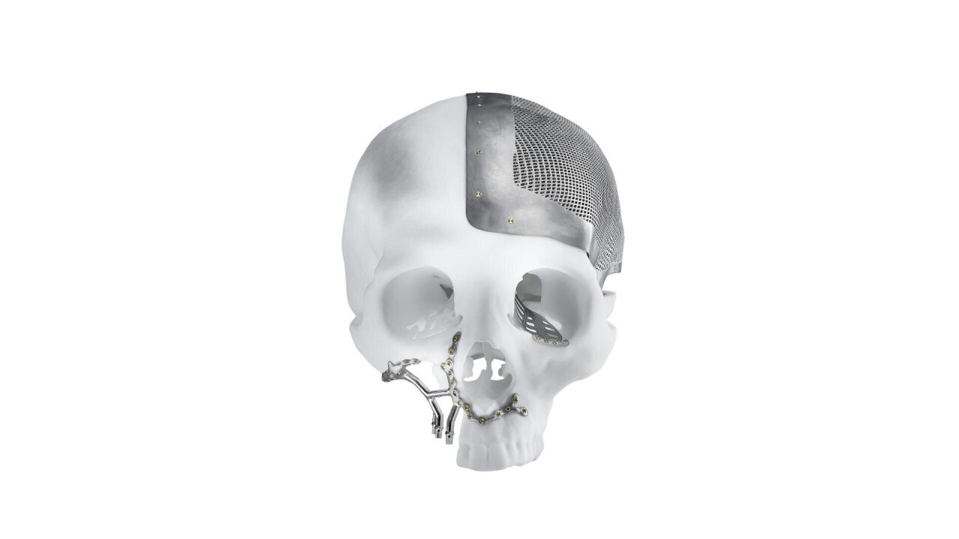 A white human skull model with multiple metal implants attached to the top, side, and jaw, demonstrating cranial and facial reconstruction techniques.